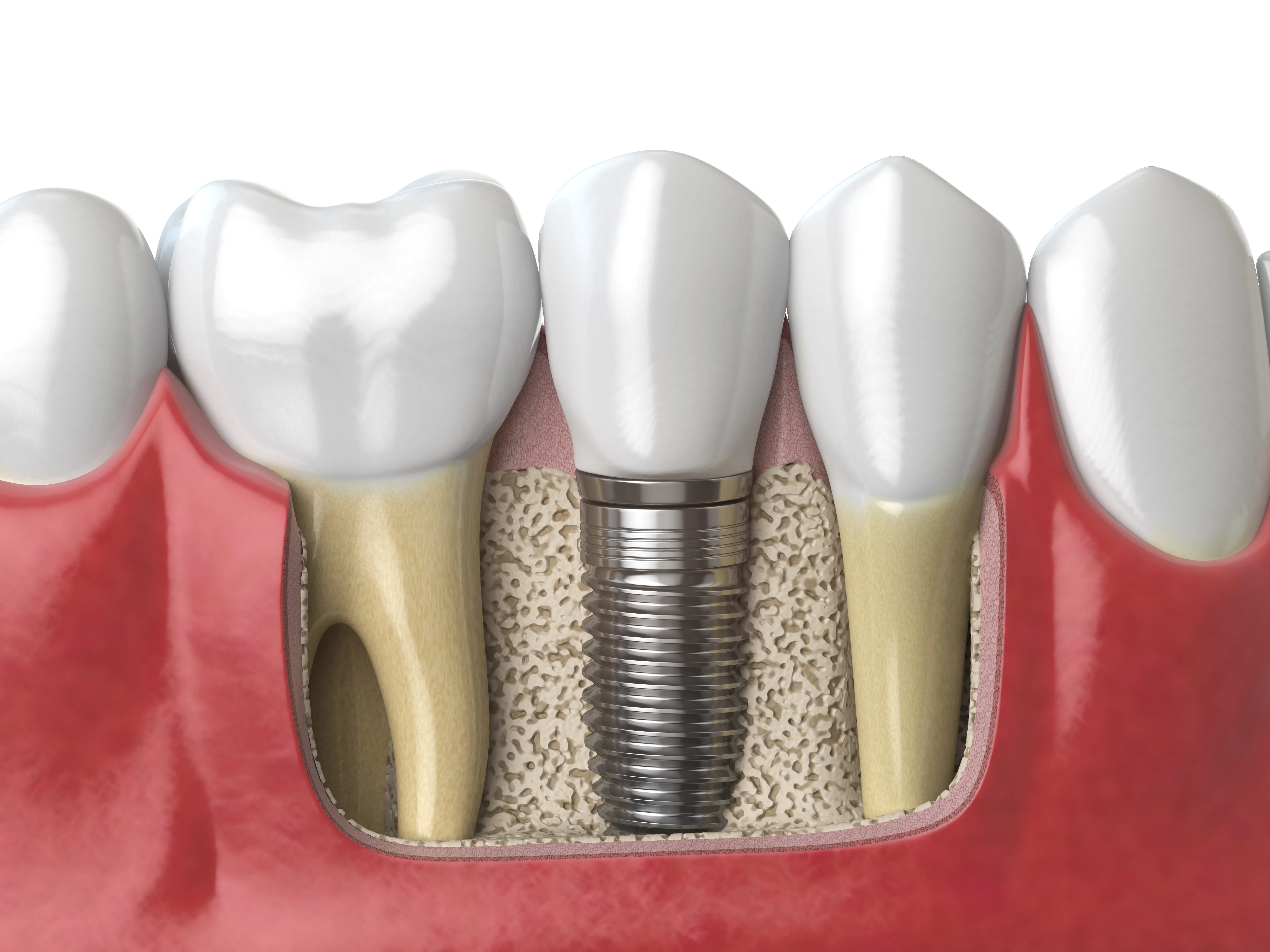 What to Expect During the Dental Implant Procedure: Step-by-Step Guide Dental Implant